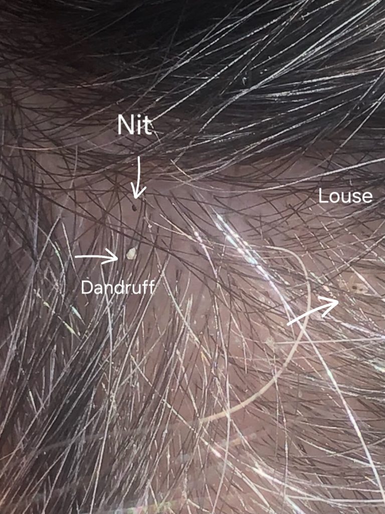 head lice nit close to scalp